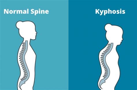 Kyphosis Humpback And Massage Lumina Massage