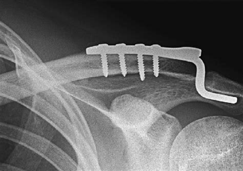 Acromioclavicular Joint Injuries Indications For Treatment And