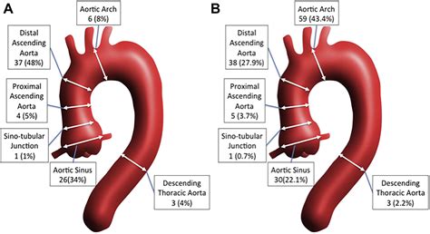 Pocket Size Mobile Echocardiographic Screening Of Thoracic Aortic