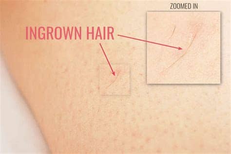 How can i get rid of it? How to Prevent Ingrown Hairs With These 7 Amazing Tips