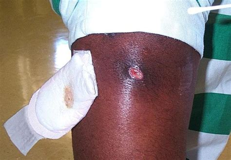 Staphylococcus aureus ist ein wie wird mrsa übertragen? MRSA - methicillin-resistenter Staphylokokkus aureus ...