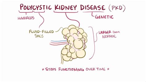 Polycystic Kidney Disease Video Anatomy And Definition Osmosis