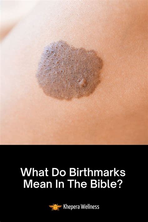 What Do Birthmarks Mean In The Bible Khepera Wellness
