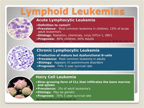 Ppt Acute Lymphocytic Leukemia Powerpoint Presentation Free