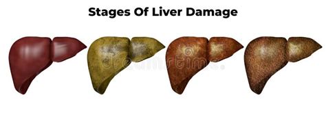 Stages Of Liver Damage The First Symptoms Of Liver Problems Are