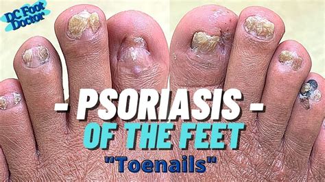 Psoriasis And The Feet Part 1 Trimming Psoriatic Nails Youtube