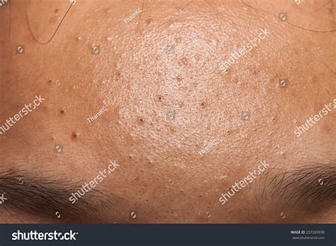 Pimple Blackheads On The Forehead Of A Teenager Stock Photo 237269938