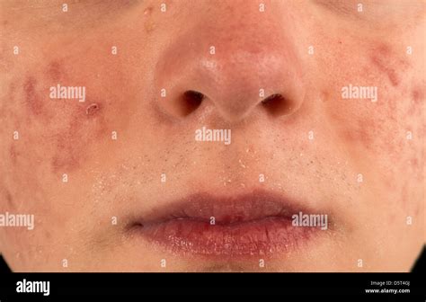 Acne Hi Res Stock Photography And Images Alamy