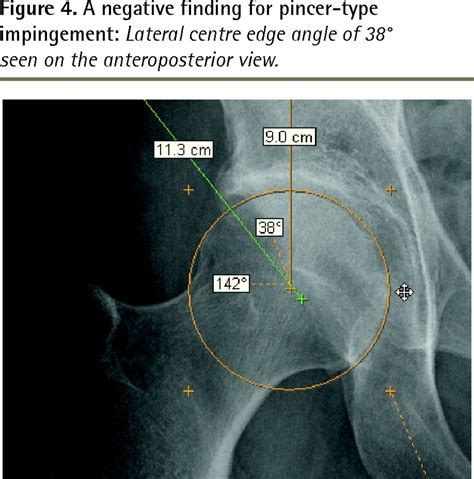 Femoroacetabular Impingement And Osteoarthritis Of The Hip The