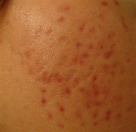 Really Bad Scars And Redmarks Scar Treatments