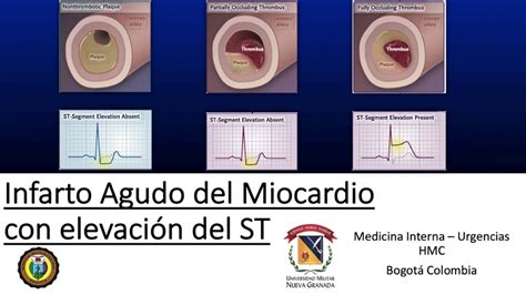 Infarto agudo del miocardio con elevación del ST PARTE IAMCEST YouTube