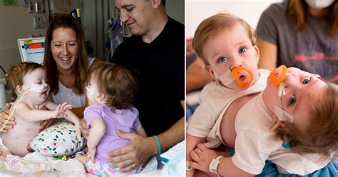 One Year Old Conjoined Twins Successfully Separated In 11 Hour Surgery News Of The World Art