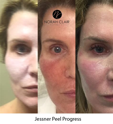 Get To Know The Beauty Of A Chemical Peel — Norah Clair Aesthetics