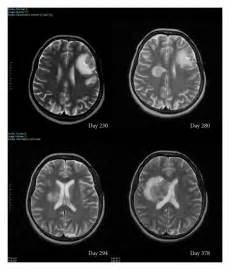 Brain Mri Of The Patient Initial Frontal Tumor That Was Surrounded By