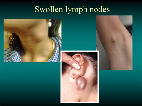 Swollen Lymph Nodes Lymphoma