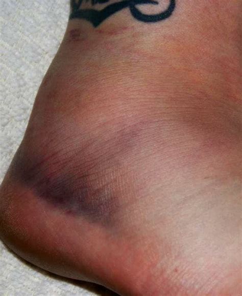 My Ankle Now 3 Days Later 2 Photos Diagrams And Topos Summitpost