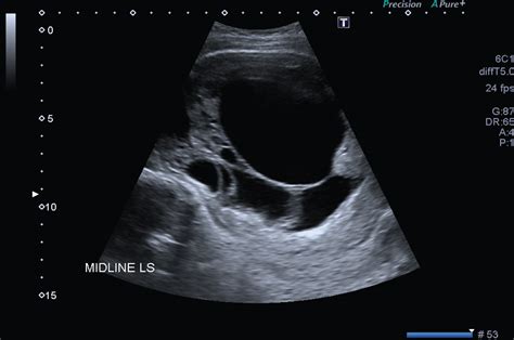 Myometrium Ultrasound