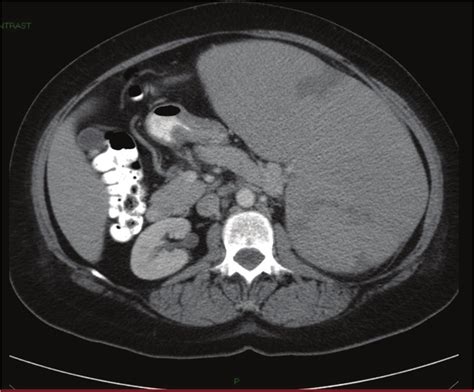 Ct Of Abdomen And Pelvis Without Contrast Showing Massive Splenomegaly