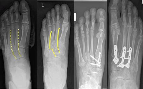 Lisfranc fracture dislocation: a review of a commonly missed injury of