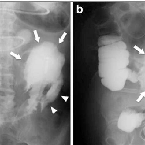 A Radiographic Study In The Small Intestine Shows A Large Cavitary