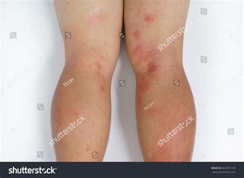 Allergic Rash Dermatitis Eczema Skin Patient Foto De Stock 667851133