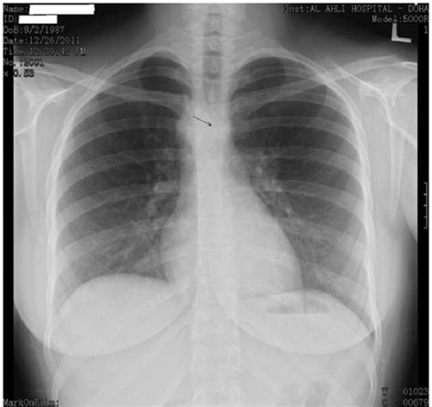 A Posteroanterior View Of Chest X Ray Showing An Abnorm Open I