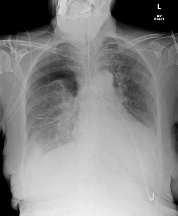 Nasogastric Tube In Left Lower Lobe With Pneumothorax Radiology Case
