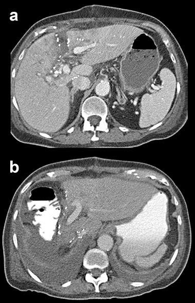 A Ct Image After The First Stage Of The Alpps Procedure Showing The In