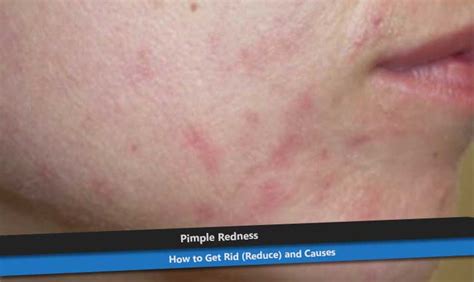Woke up with a giant zit ?? Pimple Redness - How to Get Rid (Reduce) and Causes