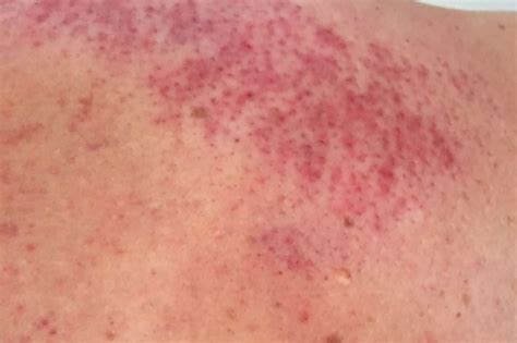 Red Blotches On Skin Not Itchy Nhs