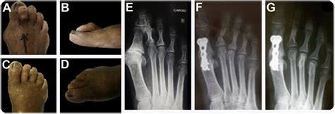 Clinical Case Of Treatment Of Second Toe Deformity Associated With