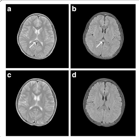 Mri Findings Of Case 2 T2 Weighted Image A And Flair Image B On