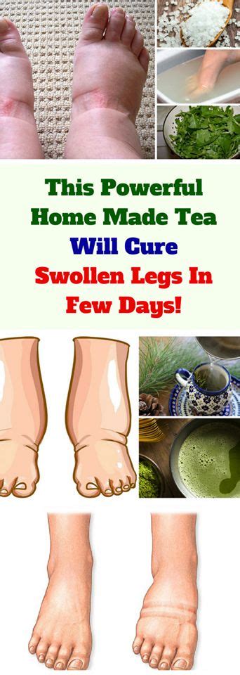 7 Best Diy To Reduce Swelling In Legs Images Foot Remedies Swollen