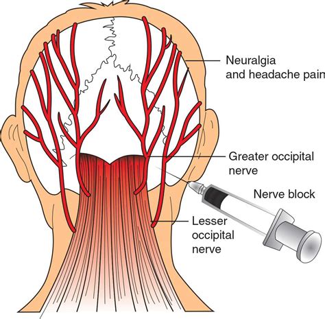 Occipital Nerve Stimulator Occipital Occipital Neuralgia Nerve Anatomy