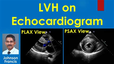 Lvh On Echocardiogram Youtube