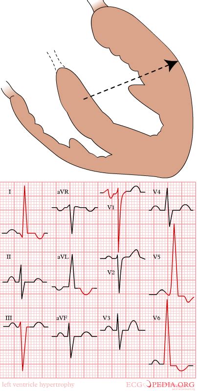 Electrocardiographic Findings In Left Ventricular Hypertrophy Wikidoc