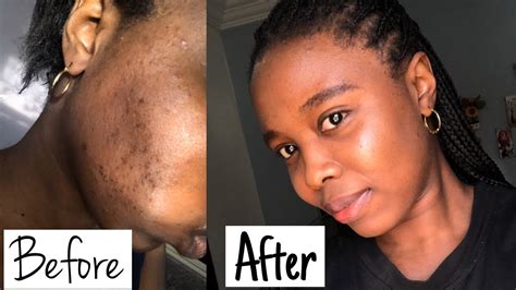 How I Cured Excema Atopic Dermatitis On Black Skin Burning