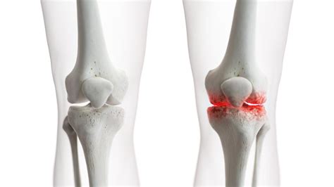 Knee Arthritis Elite Sports Medicine Orthopedics Orthopedics