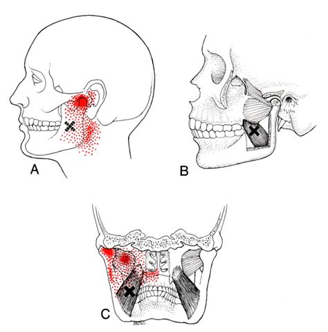 Medial Pterygoid The Trigger Point And Referred Pain Guide