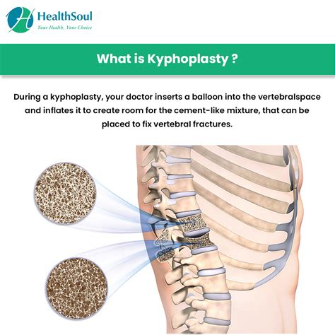 Kyphoplasty Indications And Complications Healthsoul