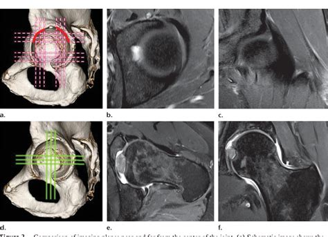Figure 3 From Demystifying Radial Imaging Of The Hip Semantic Scholar