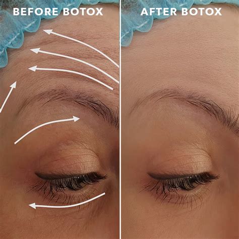Anti Wrinkle Injections Cheshire Joanne Willcox Clinics