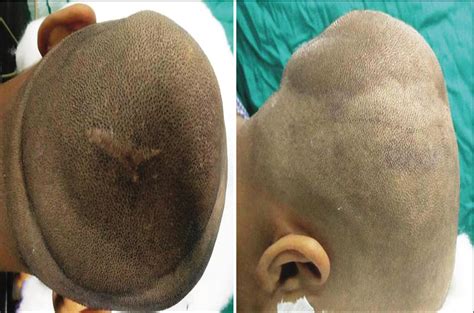 Rapidly Growing Diffuse Neurofibroma Of The Scalp With Calvarial Defect