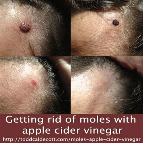 How To Get Rid Of Moles With Apple Cider Vinegar Project Nsearch