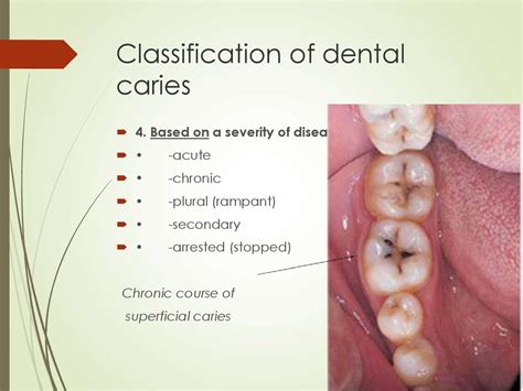 Dental Caries Classification System