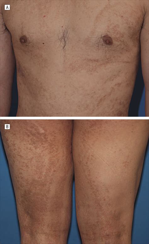 Linear And Whorled Nevoid Hypermelanosis Unique Clinical Presentations