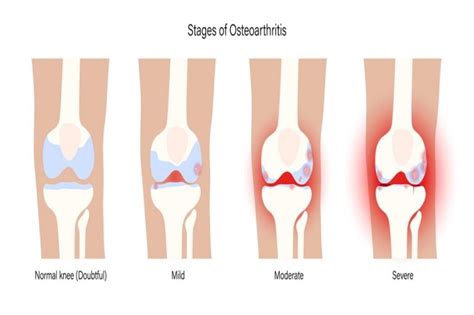 What Are The Symptoms Of Knee Arthritis Betahealthy