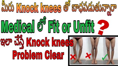 How To Loss Knock Knees In Medical Test Teluguknock Knees Test లో