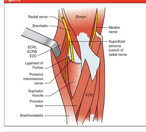 Ulnar Tunnel Syndrome Radial Tunnel Syndrome Anterior Interosseous Nerve Syndrome And