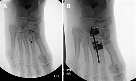 Distraction Arthroplasty In Osteoarthritis Of The Foot And Ankle
